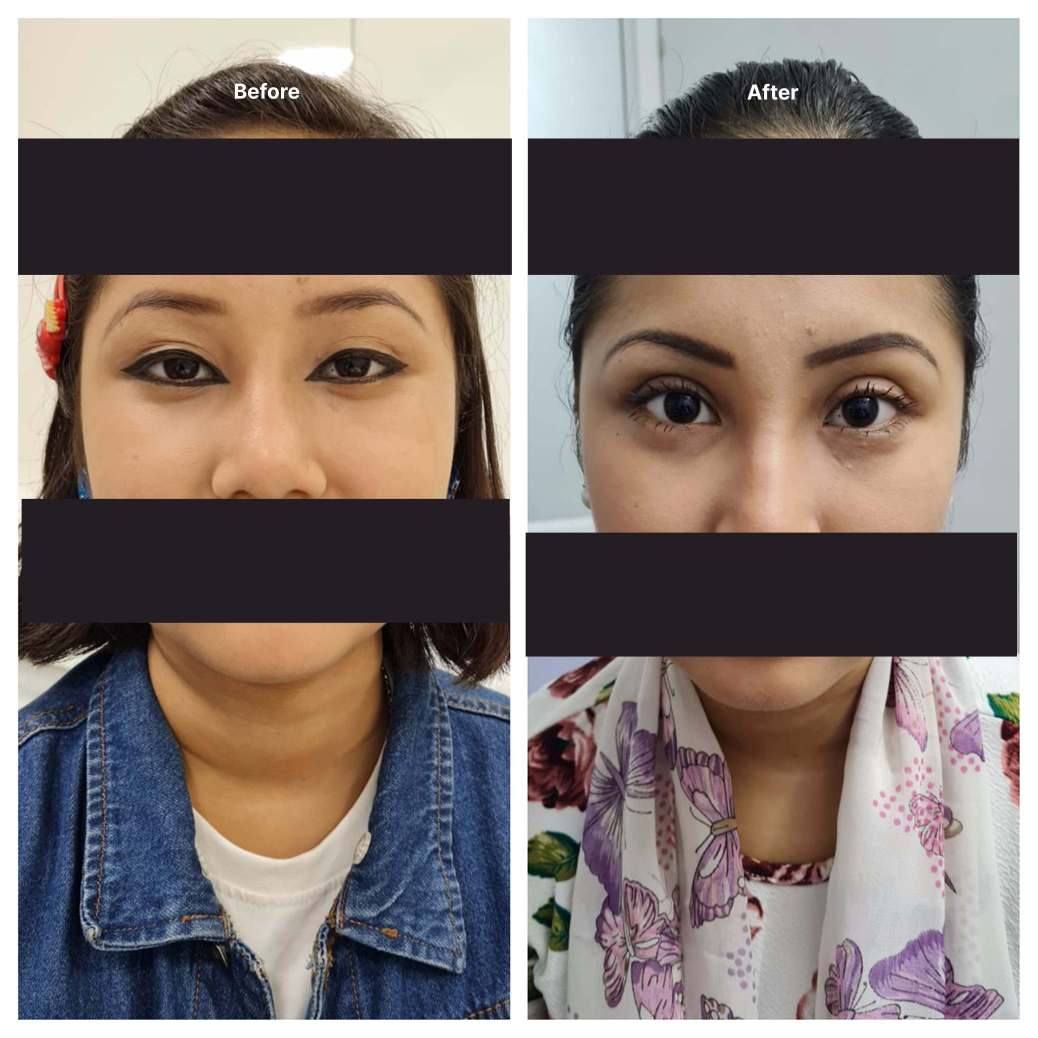 Eyelid Surgery KOQ10